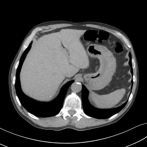 Apical pulmonary metastasis (Radiopaedia 46338-50754 B 57).png