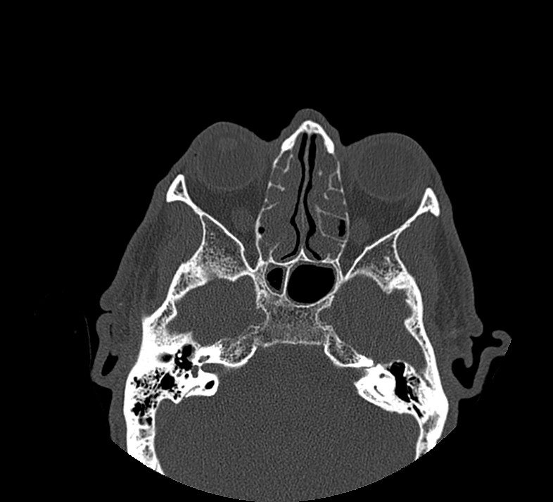 Aplastic maxillary sinuses (Radiopaedia 60030-67561 Axial non-contrast 43).jpg