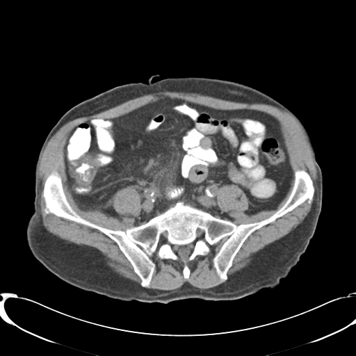 File:Appendiceal abscesses (Radiopaedia 50999-56542 Axial non-contrast 56).png