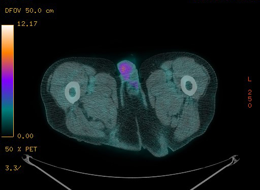 Appendiceal adenocarcinoma complicated by retroperitoneal abscess (Radiopaedia 58007-65041 Axial PET-CT 211).jpg