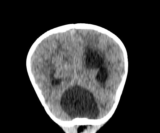 File:Arachnoid cyst-posterior fossa (Radiopaedia 88661-105370 Coronal non-contrast 62).jpg