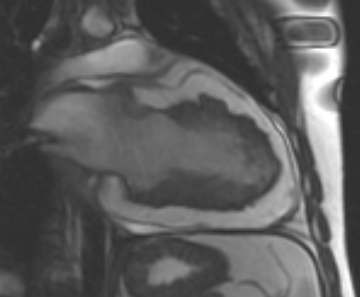 Arrhythmogenic right ventricular cardiomyopathy (Radiopaedia 69431-79307 2ch cine 12).jpg