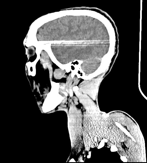 Arrow injury to the brain (Radiopaedia 72101-82607 H 20).jpg