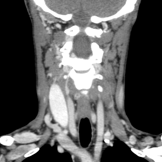 File:Arteriovenous malformation of the neck (Radiopaedia 53935-60062 D 5).jpg