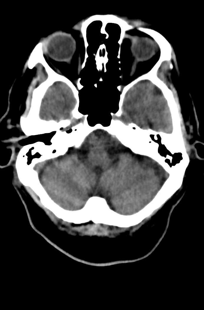 Artery of Percheron infarction (Radiopaedia 80613-94202 Axial non-contrast 48).jpg