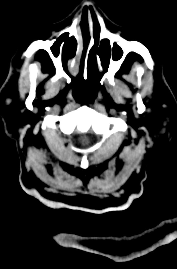 Artery of Percheron infarction (Radiopaedia 80613-94202 Axial non-contrast 6).jpg