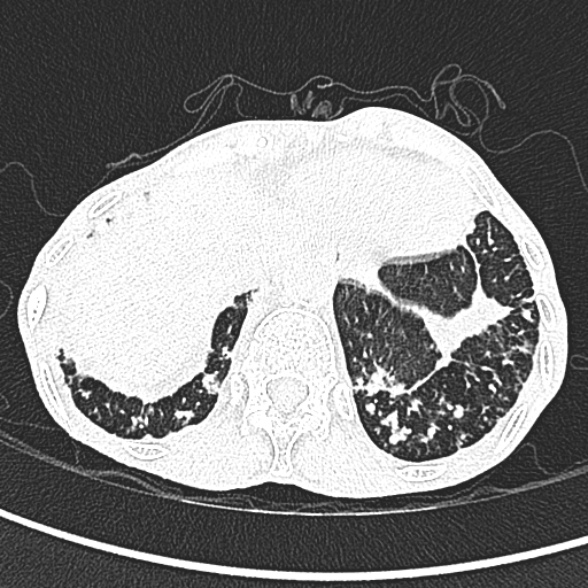 Aspergilloma- with Monod sign (Radiopaedia 44737-48532 Axial lung window 268).jpg