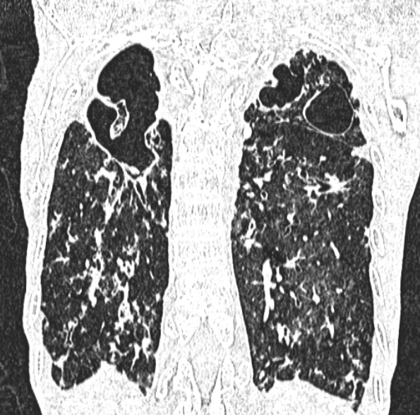 Aspergilloma- with Monod sign (Radiopaedia 44737-48532 Coronal lung window 347).jpg