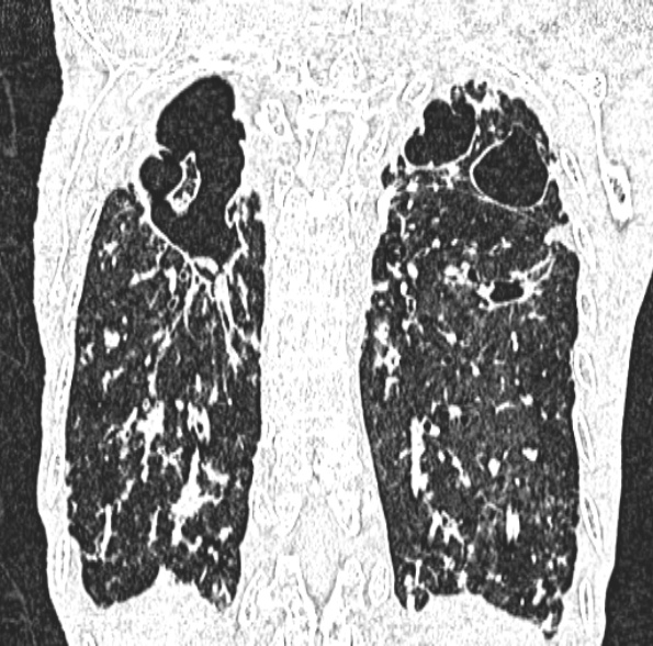 Aspergilloma- with Monod sign (Radiopaedia 44737-48532 Coronal lung window 350).jpg