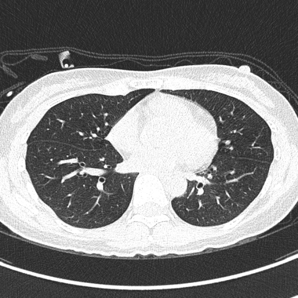 Aspergilloma (Radiopaedia 26223-26347 Axial lung window 46).jpg
