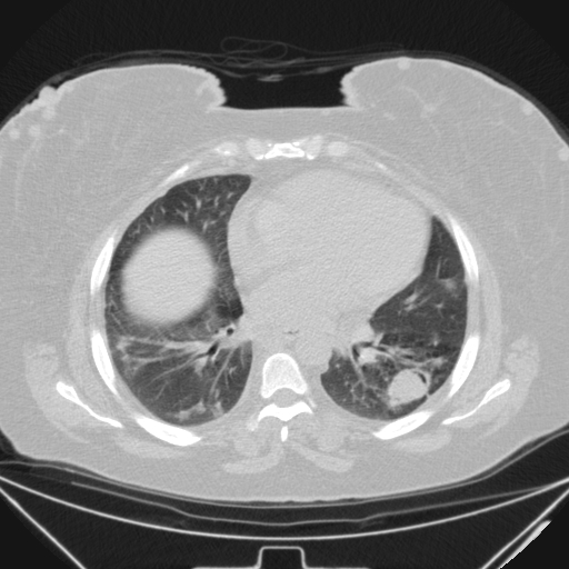 Aspergilloma (Radiopaedia 39611-41932 Axial lung window 75).jpg
