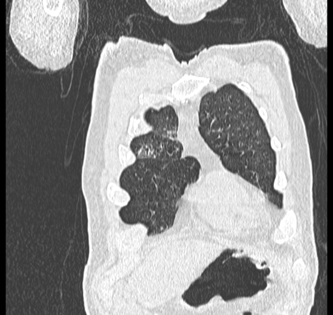 Aspergilloma (Radiopaedia 44592-48327 Coronal lung window 8).jpg