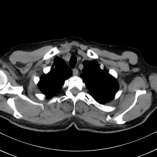 Aspergilloma on background pulmonary fibrosis (Radiopaedia 60942-68757 Axial non-contrast 10).jpg