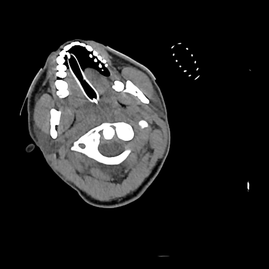 File:Atlanto-occipital dissociation (Traynelis type 1), C2 teardrop fracture, C6-7 facet joint dislocation (Radiopaedia 87655-104061 Axial non-contrast 16).jpg