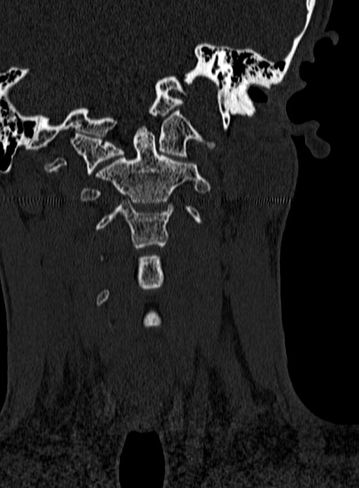 Atlantoaxial subluxation (Radiopaedia 44681-48450 Coronal bone window 28).jpg