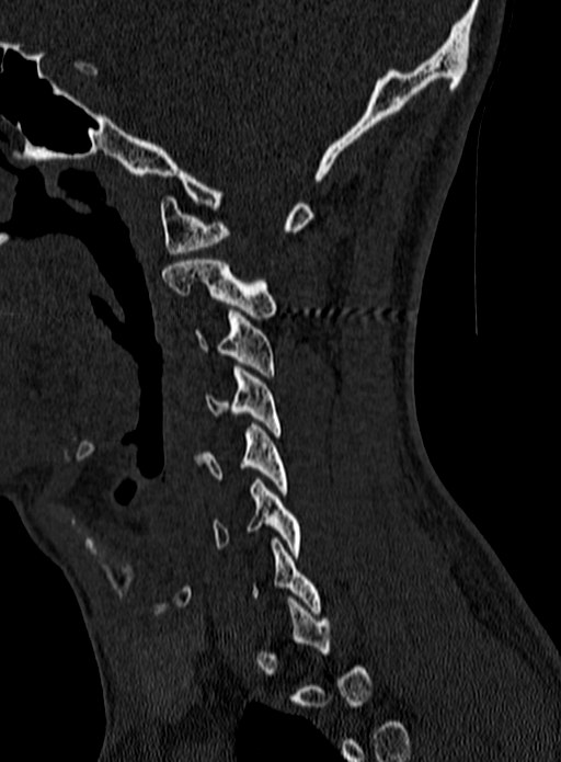 Atlantoaxial subluxation (Radiopaedia 44681-48450 Sagittal bone window 20).jpg