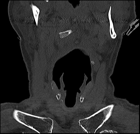 File:Atlas (type 3b subtype 1) and axis (Anderson and D'Alonzo type 3, Roy-Camille type 2) fractures (Radiopaedia 88043-104607 Coronal bone window 12).jpg