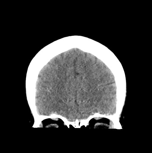 File:Atretic encephalocoele with inferior vermis hypoplasia (Radiopaedia 30443-31107 Coronal non-contrast 10).jpg