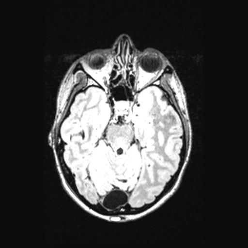 Atretic encephalocoele with inferior vermis hypoplasia (Radiopaedia 30443-31108 Axial 58).jpg