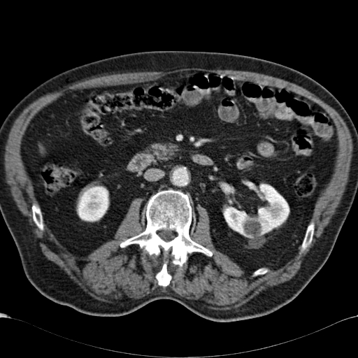 Atypical hepatocellular carcinoma (Radiopaedia 41744-44698 B 51).jpg