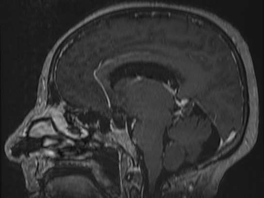 Atypical meningioma (Radiopaedia 62985-71406 Sagittal T1 C+ 42).jpg