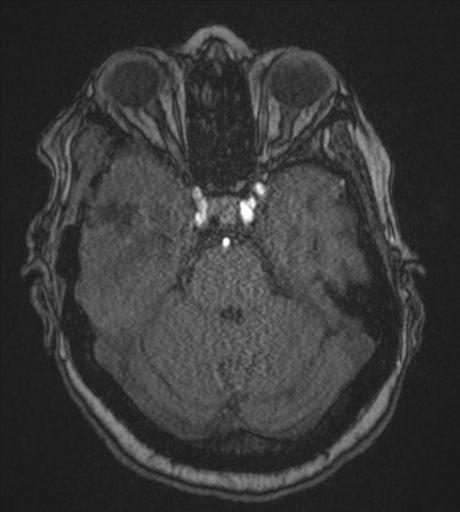 Atypical meningioma (WHO Grade II) (Radiopaedia 54742-60981 Axial MRA 31).png
