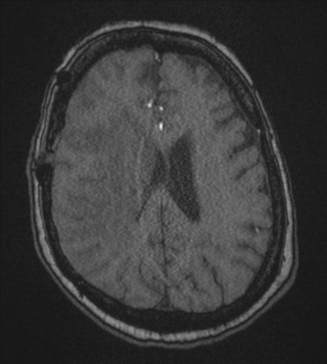 Atypical meningioma (WHO Grade II) (Radiopaedia 54742-60981 Axial MRA 66).png