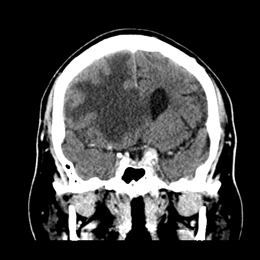 Atypical meningioma (WHO grade II) with brain invasion (Radiopaedia 57767-64728 Coronal C+ 26).png