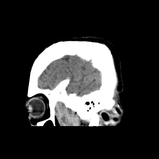 Atypical meningioma with skull invasion (Radiopaedia 34357-35649 E 8).png