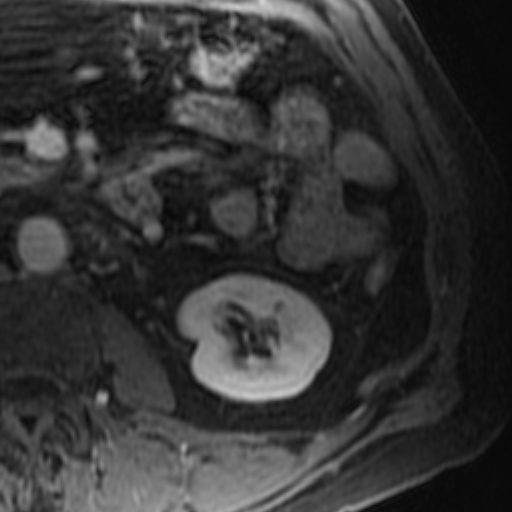 File:Atypical renal cyst on MRI (Radiopaedia 17349-17046 D 22).jpg