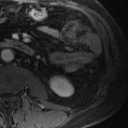 File:Atypical renal cyst on MRI (Radiopaedia 17349-17046 D 28).jpg