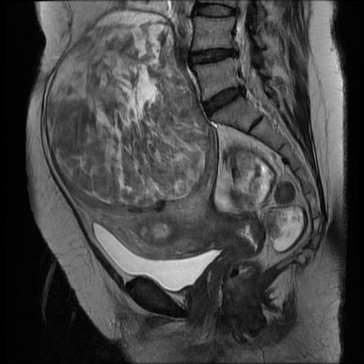 File:Atypical retroperitoneal lymphocoeles with large leiomyoma of uterus (Radiopaedia 32084-33027 Sagittal T2 17).jpg