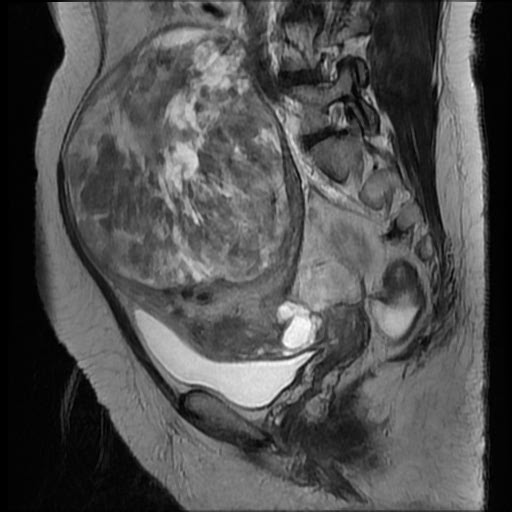 File:Atypical retroperitoneal lymphocoeles with large leiomyoma of uterus (Radiopaedia 32084-33027 Sagittal T2 19).jpg