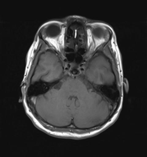 File:Autoimmune limbic encephalitis (Radiopaedia 30363-31005 Axial T1 10).jpg
