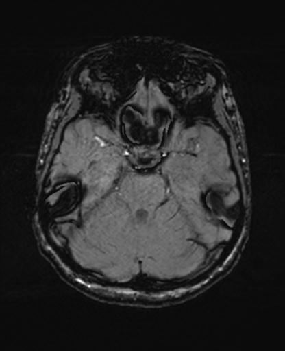 Autoimmune limbic encephalitis (Radiopaedia 30363-31005 SWI 25).jpg