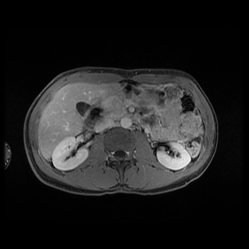 Autoimmune pancreatitis (Radiopaedia 69751-79729 Axial T1 C+ fat sat 74).jpg