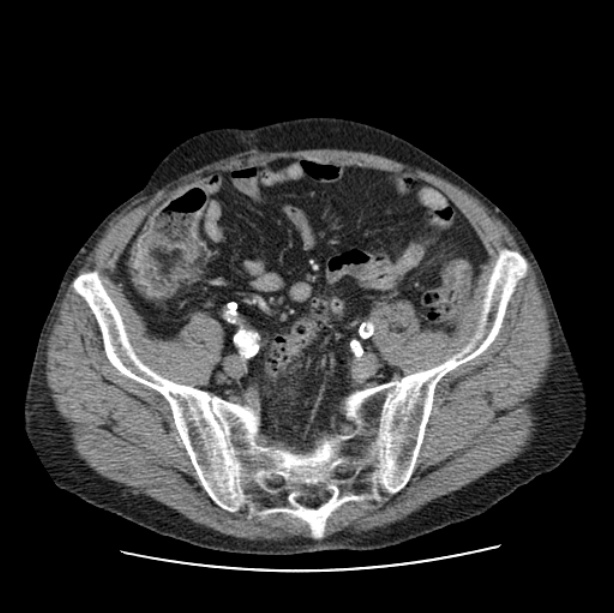 Autosomal dominant polycystic kidney disease (Radiopaedia 27851-28094 B 99).jpg