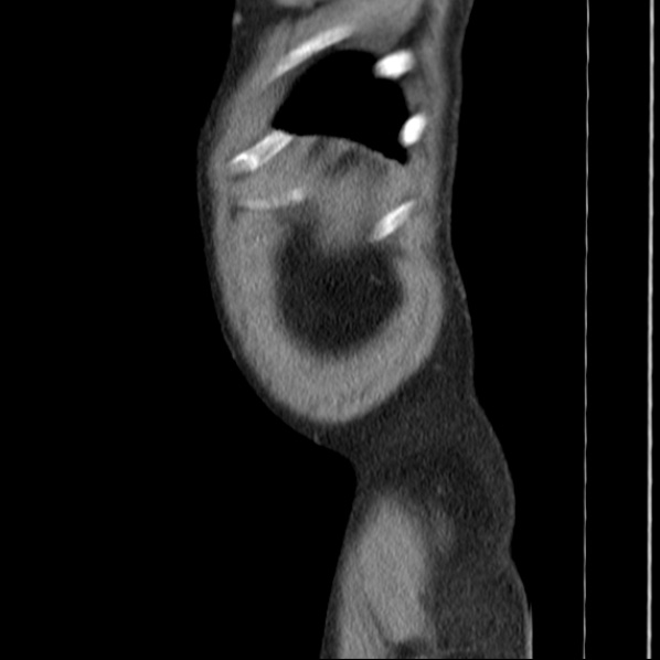 Autosomal dominant polycystic kidney disease (Radiopaedia 36539-38101 D 79).jpg