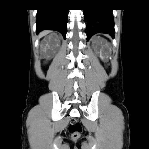 Autosomal dominant polycystic kidney disease (Radiopaedia 66349-75582 A 75).jpg