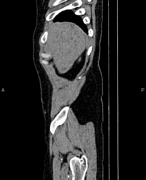 Autosomal dominant polycystic kidney disease (Radiopaedia 87830-104287 C 4).jpg