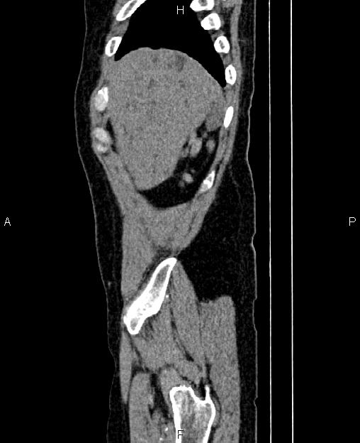 Autosomal dominant polycystic kidney disease (Radiopaedia 87830-104287 C 6).jpg