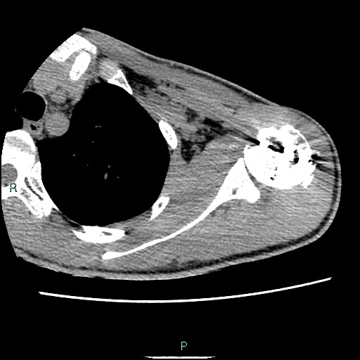 Avascular necrosis after fracture dislocations of the proximal humerus (Radiopaedia 88078-104653 D 38).jpg