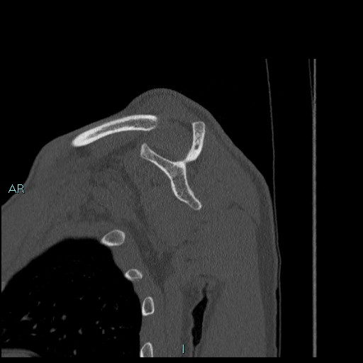 Avascular necrosis after fracture dislocations of the proximal humerus (Radiopaedia 88078-104655 Sagittal bone window 39).jpg