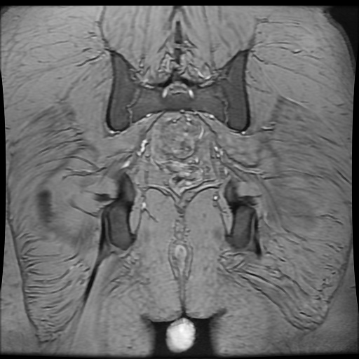 Avascular necrosis of the hip (Radiopaedia 61503-69465 F 88).jpg