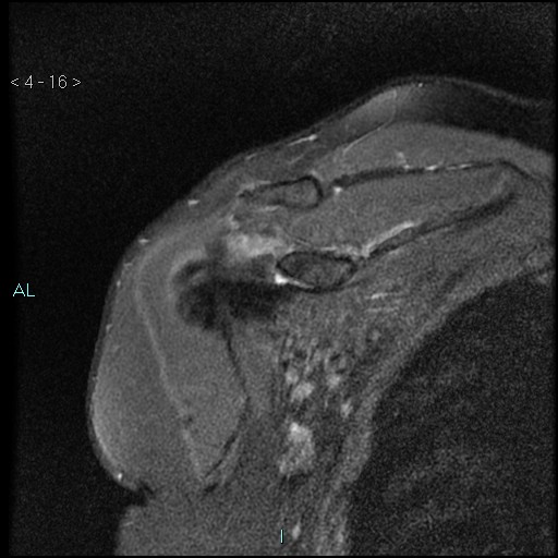 File:Avascular necrosis of the shoulder - Cruess stage I (Radiopaedia 77674-89886 Coronal PD fat sat 16).jpg