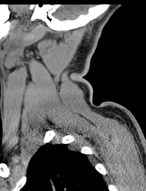 Axis peg fracture (type 3) and atlas lateral mass (type 4) fracture (Radiopaedia 37474-39324 D 3).png