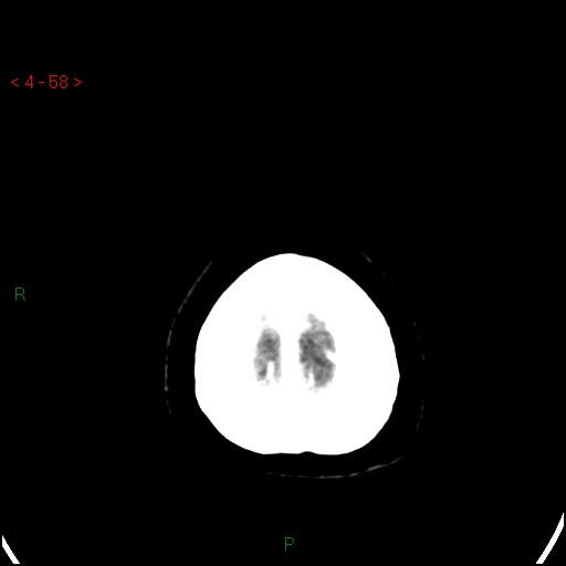 Azygos anterior cerebral artery (Radiopaedia 51987-57833 A 58).jpg