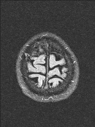 File:Balo concentric sclerosis (Radiopaedia 50458-55940 Axial FLAIR 3).jpg