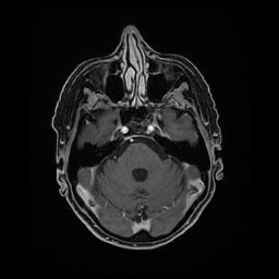 Balo concentric sclerosis (Radiopaedia 53875-59982 Axial LAVA C+ 77).jpg