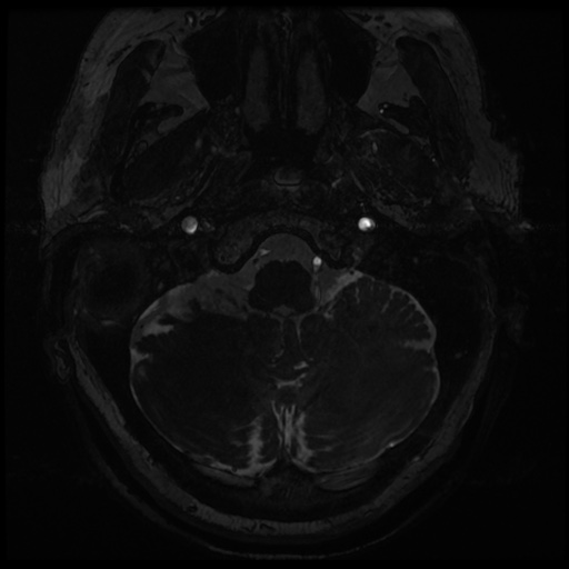 Balo concentric sclerosis (Radiopaedia 53875-59982 Axial T2 FIESTA 6).jpg